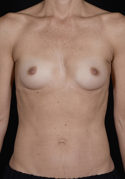 Breast Augmentation | Manhattan | New York City (NYC)