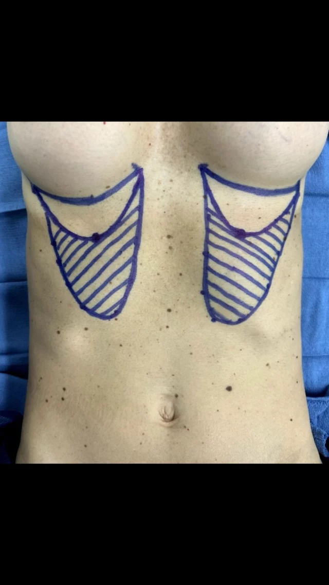 Reverse abdominoplasty is named as such because loose abdominal skin is pulled up and removed instead of downward like the classic abdominoplasty. It really is a very narrow demographic that is suitable for this though. Rectus diastasis (postpartum muscle laxity) cannot be treated with this procedure. The most ideal patient is a thin individual with a perfect lower abdomen who has preexisting breast scars underneath. 

#breast #scars #skin