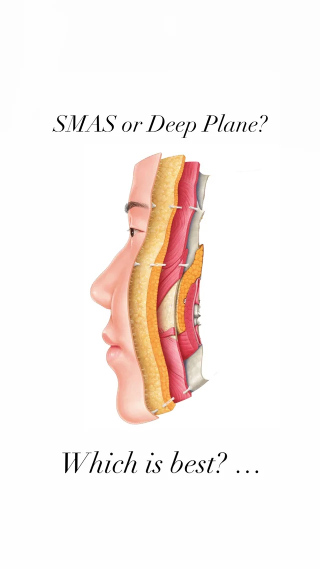 Patient’s often ask, which method is better, SMAS or deep plane?  If there was a clear superiority, all surgeons would be using the same technique. Put another way, as our nurse Meghan says, “it’s not the racquet, it’s the player”. True here too. 

SMAS is an acronym for  a medical term: Superficial MusculoAponeurotic System. Structurally it is a sheet of fibrous and fatty tissue that can be tightened to recreate a more youthful facial shape. 

#face #lift #young