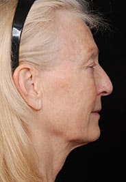 Facelift Surgery | Manhattan | New York City (NYC)