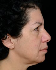 Facelift Surgery | Manhattan | New York City (NYC)