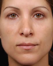 Facelift Surgery | Manhattan | New York City (NYC)