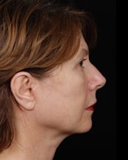 Facelift Surgery | Manhattan | New York City (NYC)