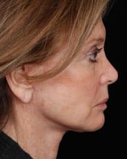 Facelift Surgery | Manhattan | New York City (NYC)