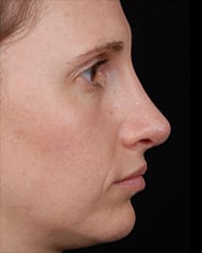 Facelift Surgery | Manhattan | New York City (NYC)