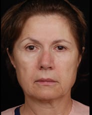 Facelift Surgery | Manhattan | New York City (NYC)