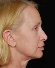 Facelift Surgery | Manhattan | New York City (NYC)