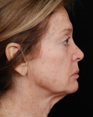 Facelift Surgery | Manhattan | New York City (NYC)