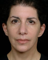 Facelift Surgery | Manhattan | New York City (NYC)