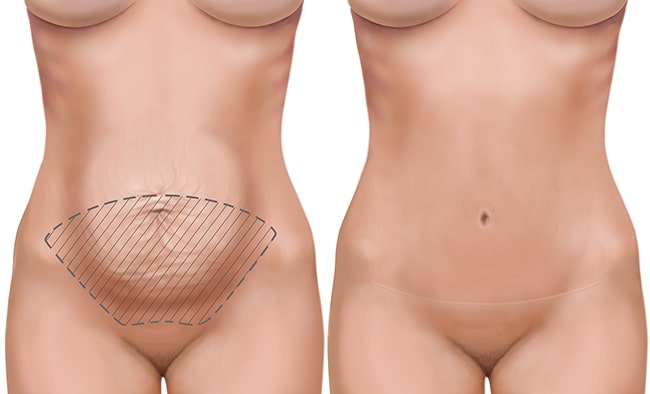 Abdominoplasty - David Hidalgo, MD FACS