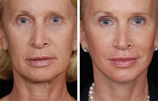 Rhytidectomy (facelift surgery) patient
