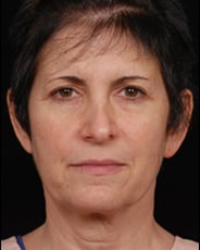 Facelift Surgery | Manhattan | New York City (NYC)