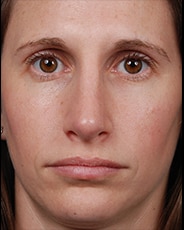 Facelift Surgery | Manhattan | New York City (NYC)