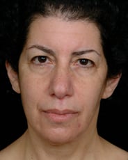 Facelift Surgery | Manhattan | New York City (NYC)