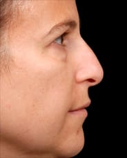 Facelift Surgery | Manhattan | New York City (NYC)