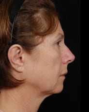 Facelift Surgery | Manhattan | New York City (NYC)