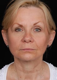 Facelift Surgery | Manhattan | New York City (NYC)