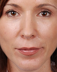 Facelift Surgery | Manhattan | New York City (NYC)