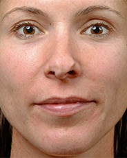 Facelift Surgery | Manhattan | New York City (NYC)