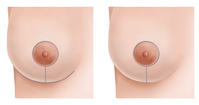 Breast Reduction - Female - David Hidalgo, MD FACS