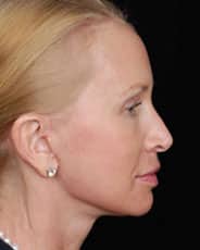 Facelift Surgery | Manhattan | New York City (NYC)