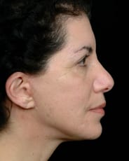 Facelift Surgery | Manhattan | New York City (NYC)