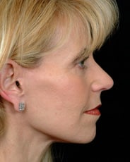 Facelift Surgery | Manhattan | New York City (NYC)