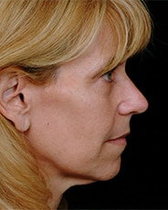 Facelift Surgery | Manhattan | New York City (NYC)