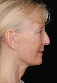 Facelift Surgery | Manhattan | New York City (NYC)