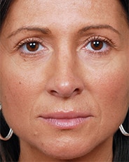 Facelift Surgery | Manhattan | New York City (NYC)