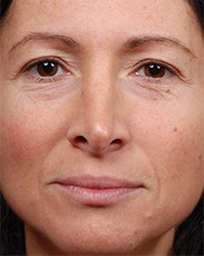 Facelift Surgery | Manhattan | New York City (NYC)