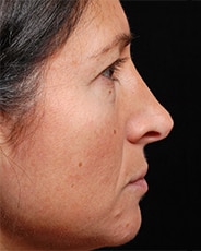 Facelift Surgery | Manhattan | New York City (NYC)