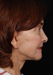 Facelift Surgery | Manhattan | New York City (NYC)