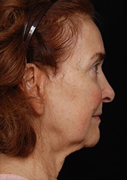 Facelift Surgery | Manhattan | New York City (NYC)