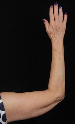 Facelift Surgery | Manhattan | New York City (NYC)