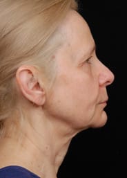 Facelift Surgery | Manhattan | New York City (NYC)