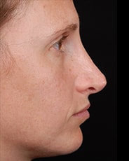 Facelift Surgery | Manhattan | New York City (NYC)