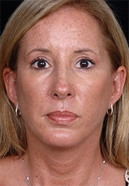 Facelift Surgery | Manhattan | New York City (NYC)