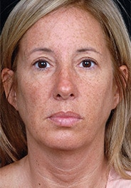 Facelift Surgery | Manhattan | New York City (NYC)