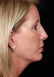 Facelift Surgery | Manhattan | New York City (NYC)