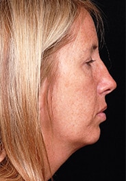 Facelift Surgery | Manhattan | New York City (NYC)