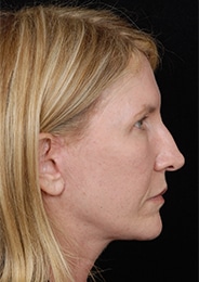 Facelift Surgery | Manhattan | New York City (NYC)