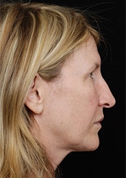 Facelift Surgery | Manhattan | New York City (NYC)