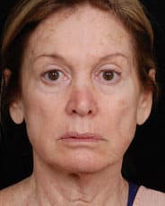 Facelift Surgery | Manhattan | New York City (NYC)