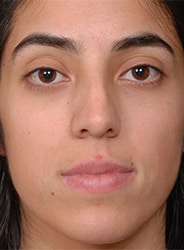 Facelift Surgery | Manhattan | New York City (NYC)