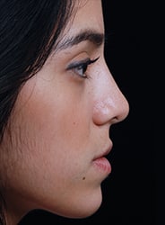 Facelift Surgery | Manhattan | New York City (NYC)