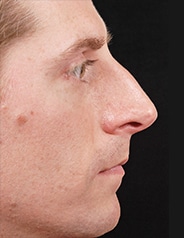 Facelift Surgery | Manhattan | New York City (NYC)