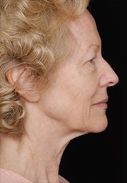 Facelift Surgery | Manhattan | New York City (NYC)