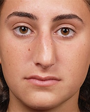 Facelift Surgery | Manhattan | New York City (NYC)