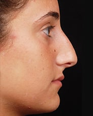 Facelift Surgery | Manhattan | New York City (NYC)